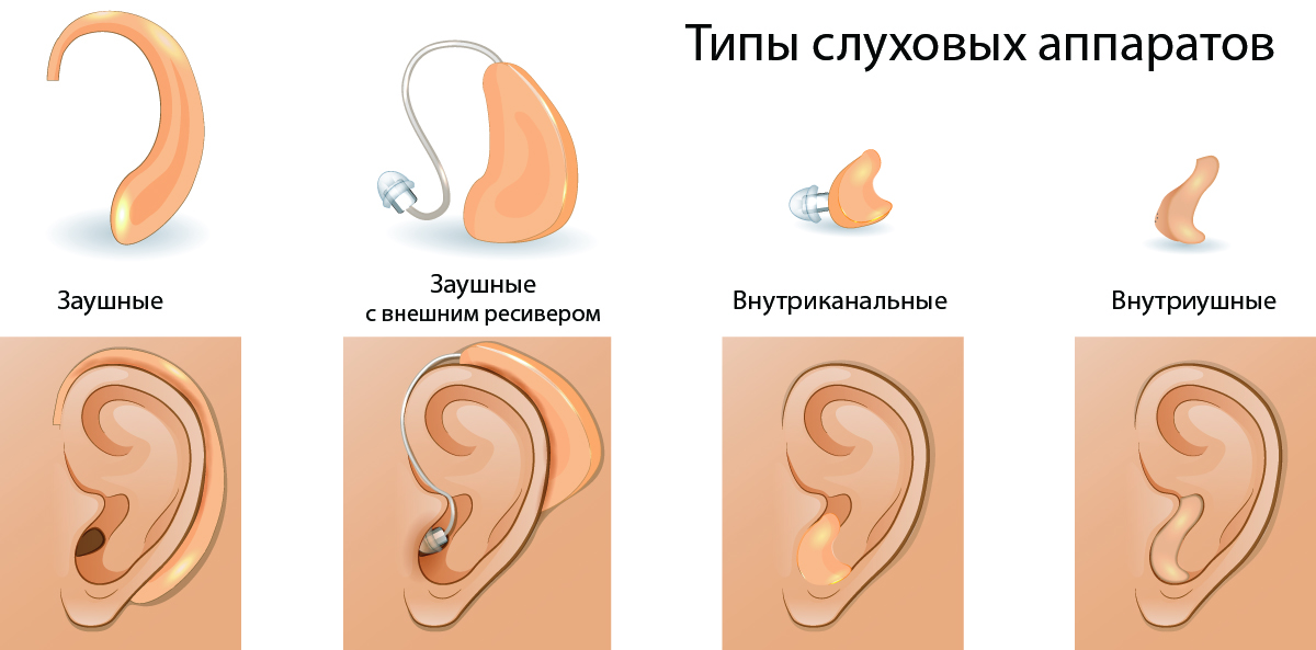 Как выбрать слуховой аппарат: виды, отличия, примеры