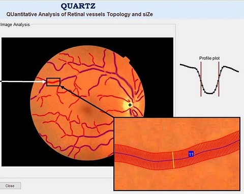 К примеру, еще 2 года назад ученые Лондонского университета Святого Георгия разработали алгоритм QUARTZ, который менее, чем за минуту сканирует сетчатку глаза и на основе результата опред...